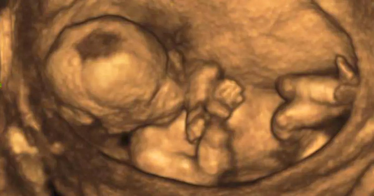 screening schwangerschaft - Sollte man das Ersttrimester-Screening machen