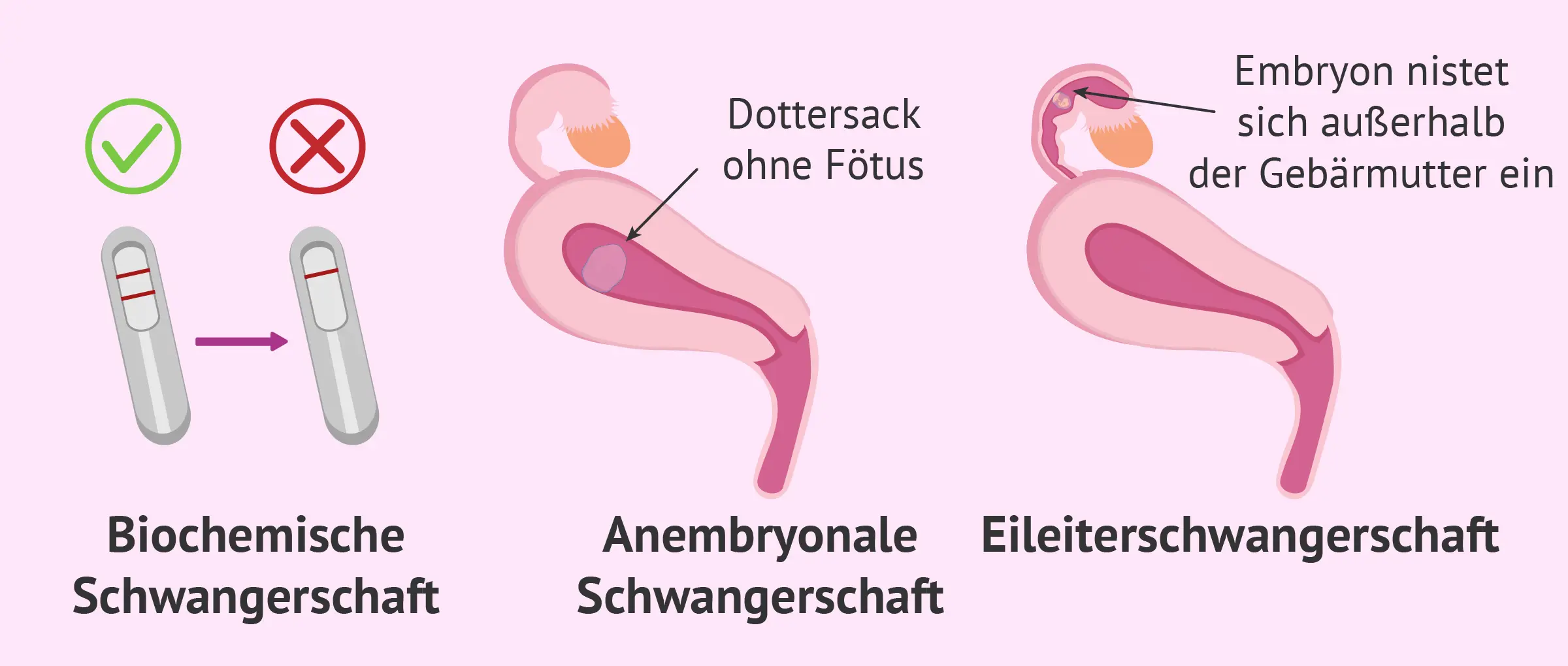chemische schwangerschaft erkennen - Wann Abgang bei biochemischer Schwangerschaft