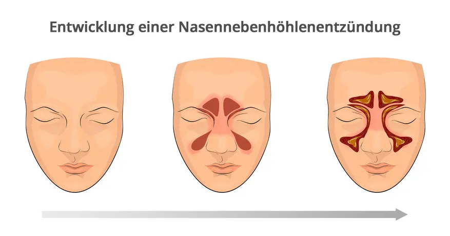 nasennebenhöhlenentzündung schwangerschaft wann zum arzt - Wann bei einer Nasennebenhöhlenentzündung zum Arzt