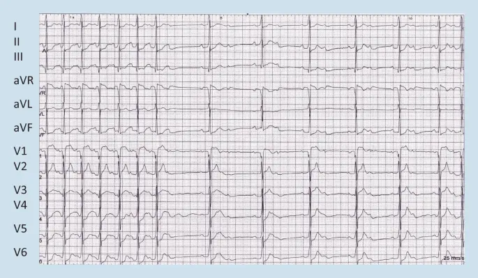 ekg schwangerschaft - Wann darf man kein EKG machen
