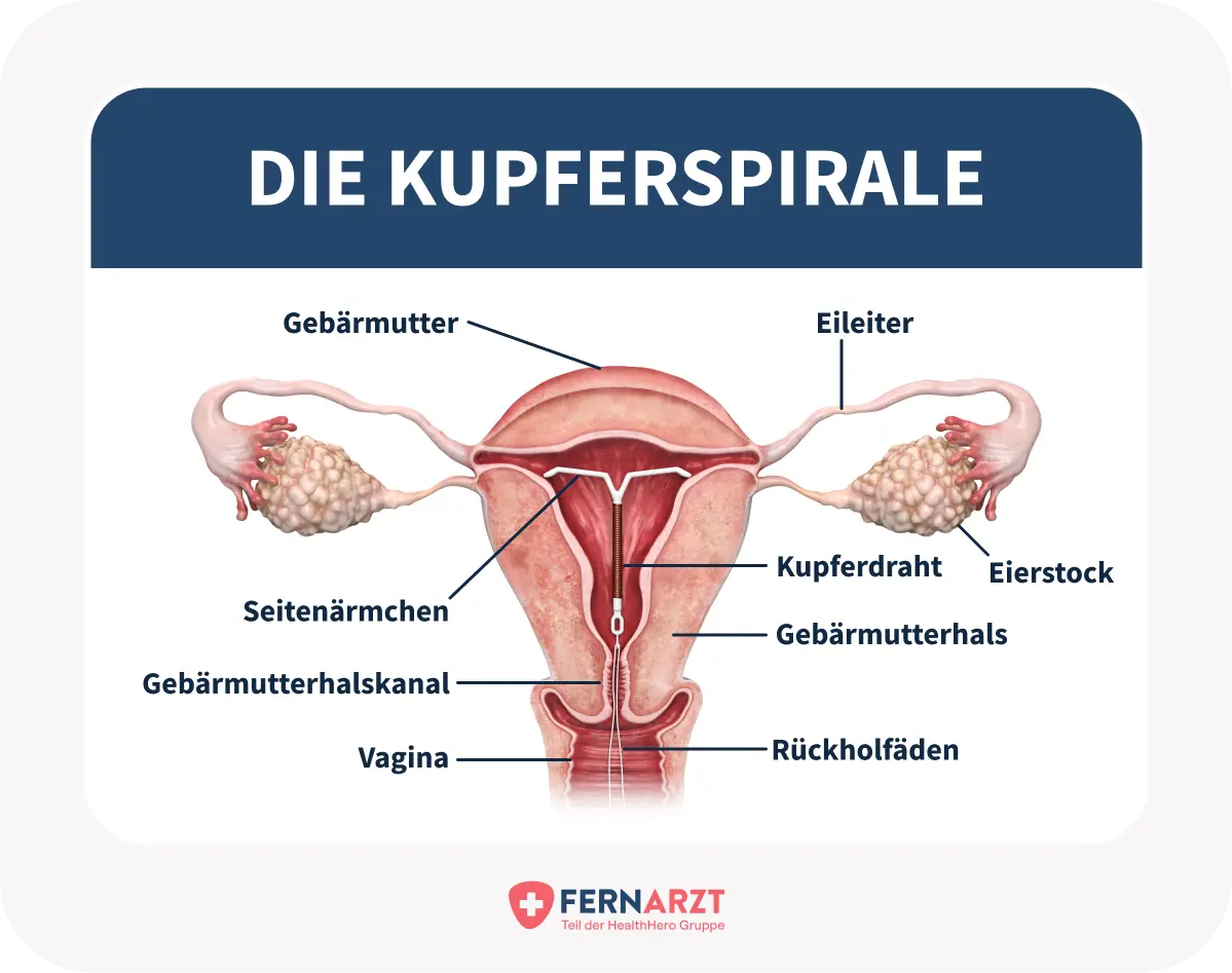 ab wann kann man nach der geburt spirale einsetzen - Wann darf man keine Spirale einsetzen