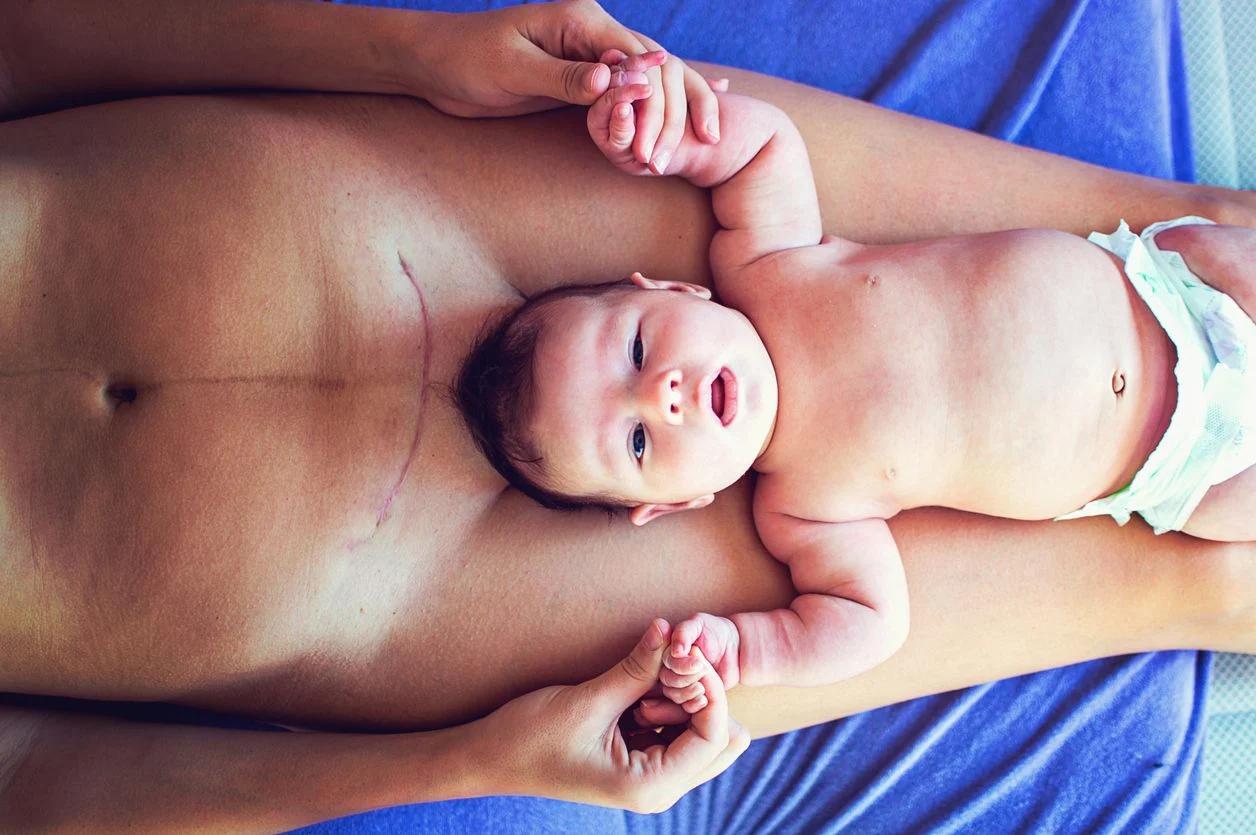 kaiserschnitt oder normale geburt forum - Wann entscheidet man sich für einen Kaiserschnitt