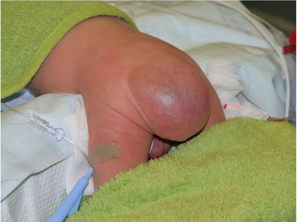 vorhaut entzündet kind wann zum arzt - Wann geht eine Vorhaut Entzündung weg