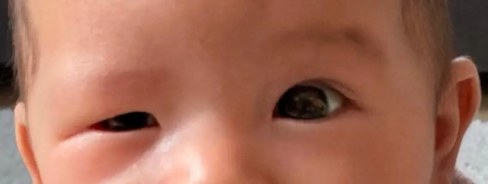 Fazialisparese während der Schwangerschaft: Erfahrungen und Informationen - Wann geht Fazialisparese weg fazialisparese schwangerschaft erfahrungen - Wann geht Fazialisparese weg