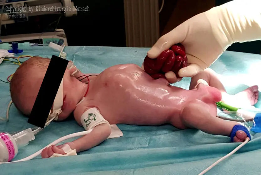 baby im darm gewachsen - Wann hat sich der Darm beim Baby ausgereift