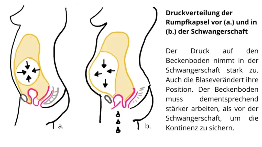 blasenschwäche schwangerschaft - Wann Inkontinenz Schwangerschaft