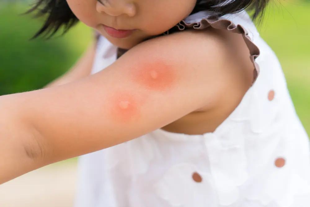 insektenstich bei kindern - Wann ins Krankenhaus Insektenstich