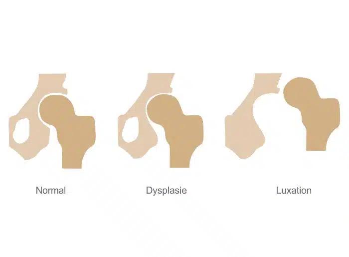 hüftdysplasie baby anzeichen - Wann ist die Hüfte bei Babys ausgereift