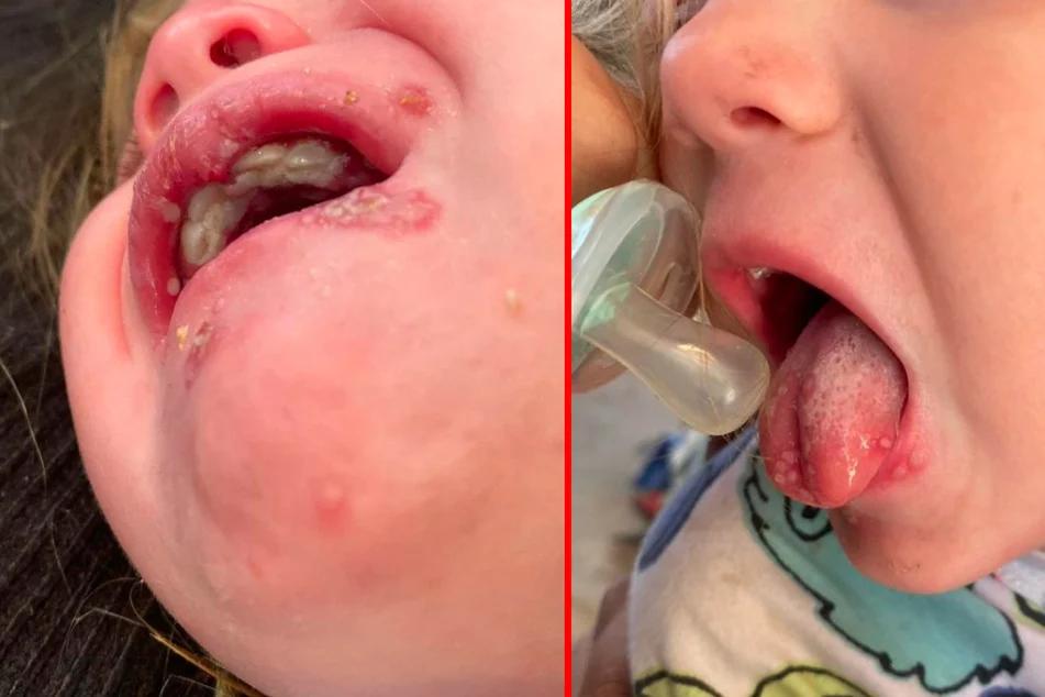 lippenherpes baby geküsst - Wann ist ein Lippenherpes nicht mehr ansteckend