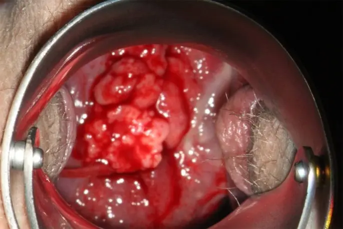 kolposkopie schwangerschaft - Wann ist eine Kolposkopie notwendig