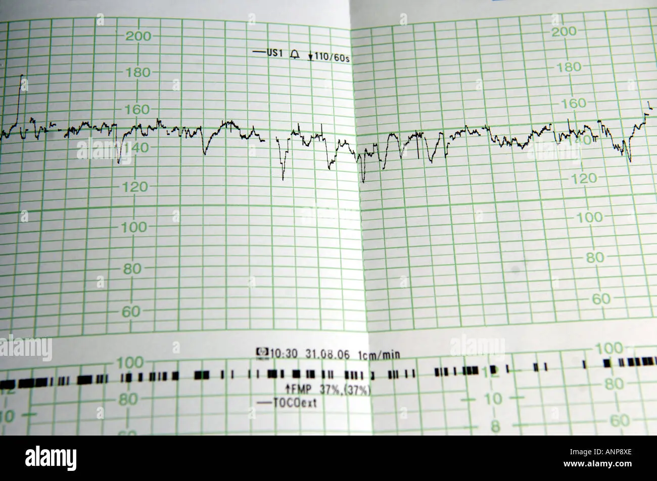 ekg schwangerschaft - Wann ist EKG sinnvoll