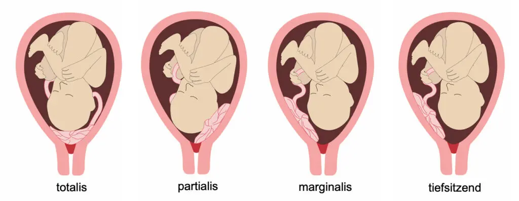 plazenta praevia marginalis geburt - Wann Kaiserschnitt bei Plazenta praevia marginalis