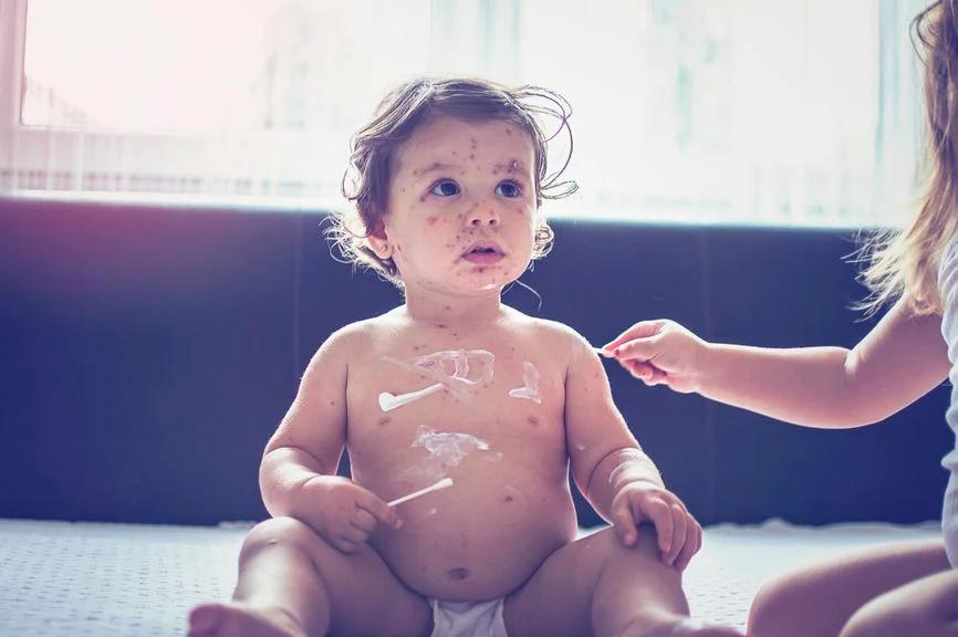 pfeiffersches drüsenfieber kleinkind kindergarten - Wann Kita nach Pfeifferschem Drüsenfieber