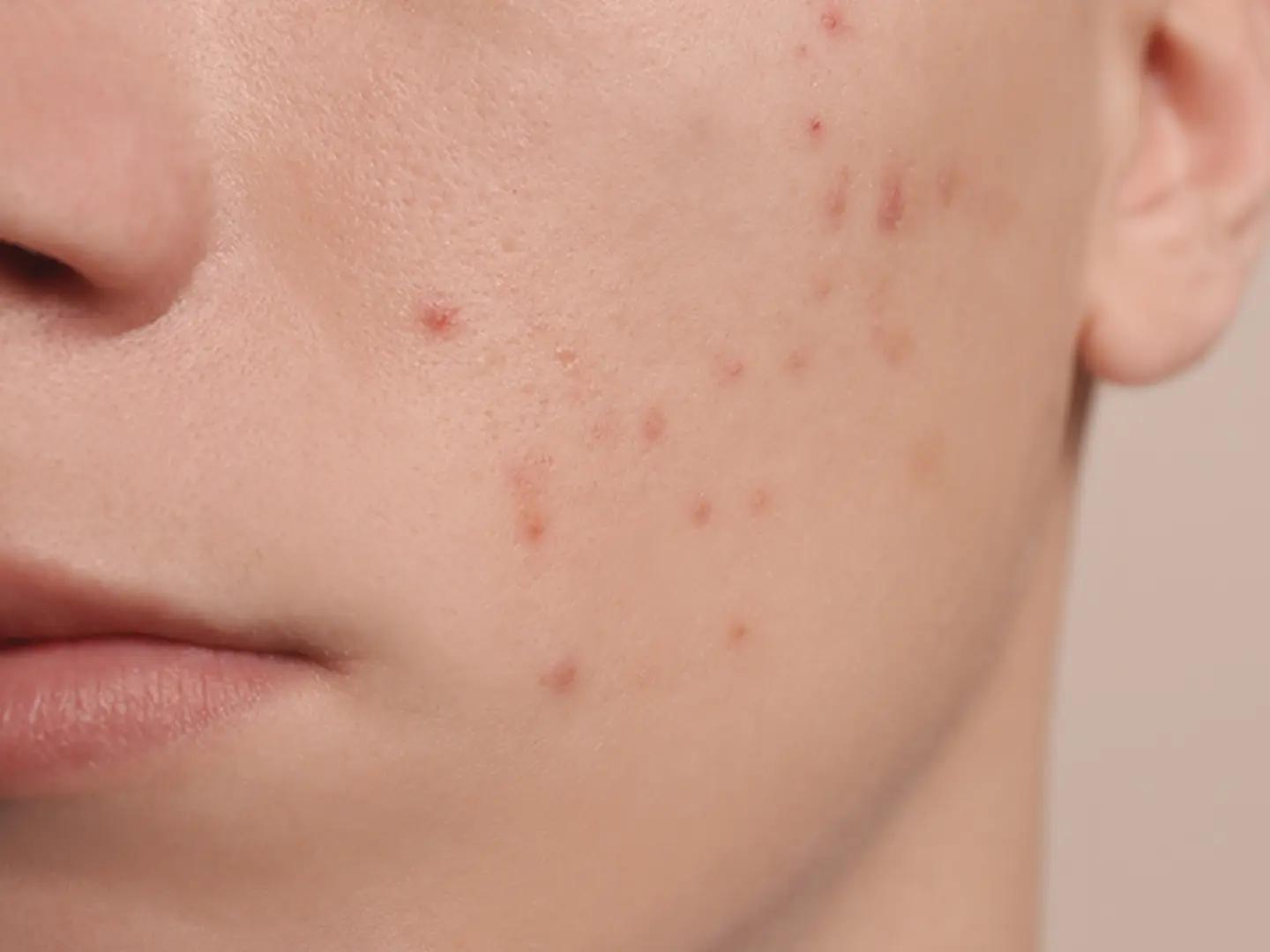 ab wann schöne haut in der schwangerschaft - Wann kommt der Schwangerschaftsglow