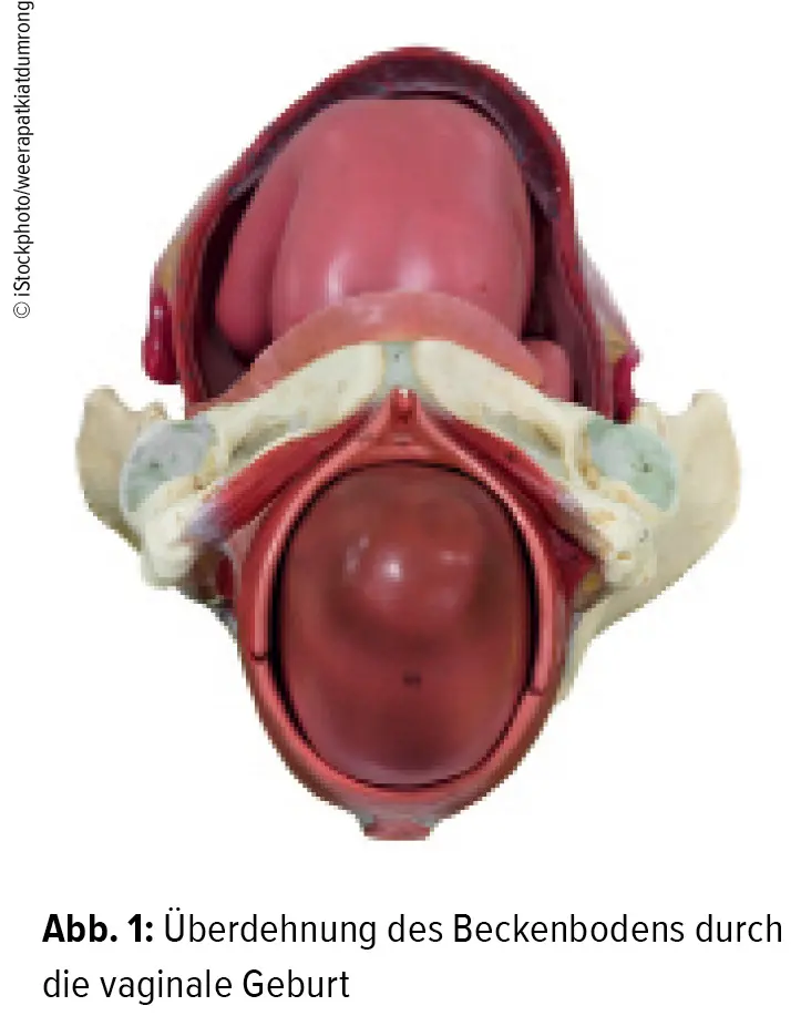 beckenboden op nach geburt - Wann muss der Beckenboden operiert werden