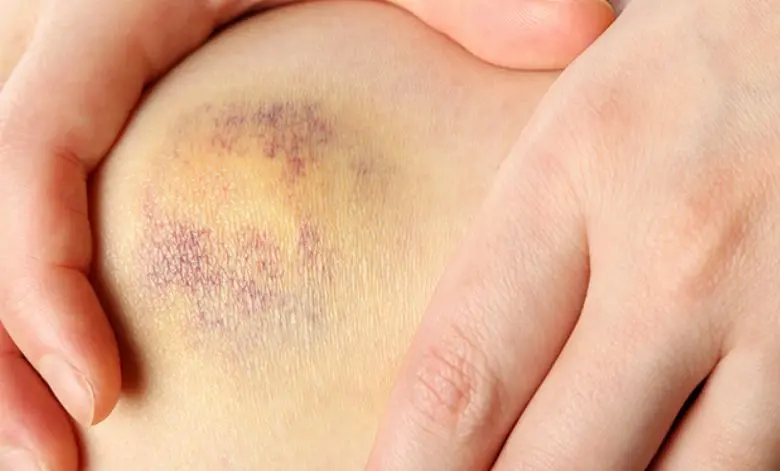 Hämatom nach Operation: Ursachen, Behandlung und Tipps - Wann muss ein Hämatom operativ entfernt werden hämatom nach geburt op - Wann muss ein Hämatom operativ entfernt werden