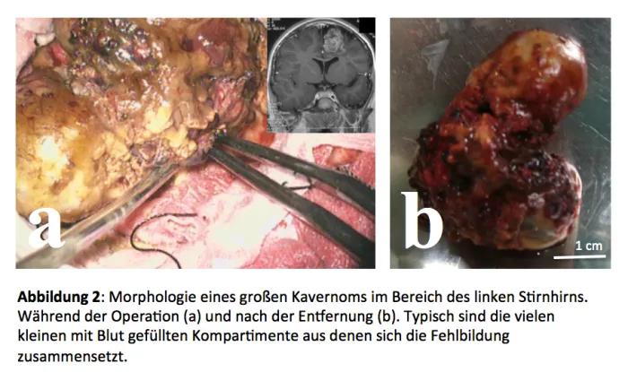 Kavernome: Was Sie über diese Gefäßmissbildungen wissen sollten - Wann muss ein Kavernom operiert werden kavernom geburt - Wann muss ein Kavernom operiert werden