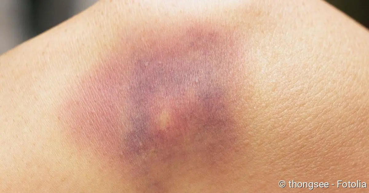 Prellung Kind: Wann zum Arzt? - Wann müssen Kinder nach einem Sturz zum Arzt prellung kind wann zum arzt - Wann müssen Kinder nach einem Sturz zum Arzt