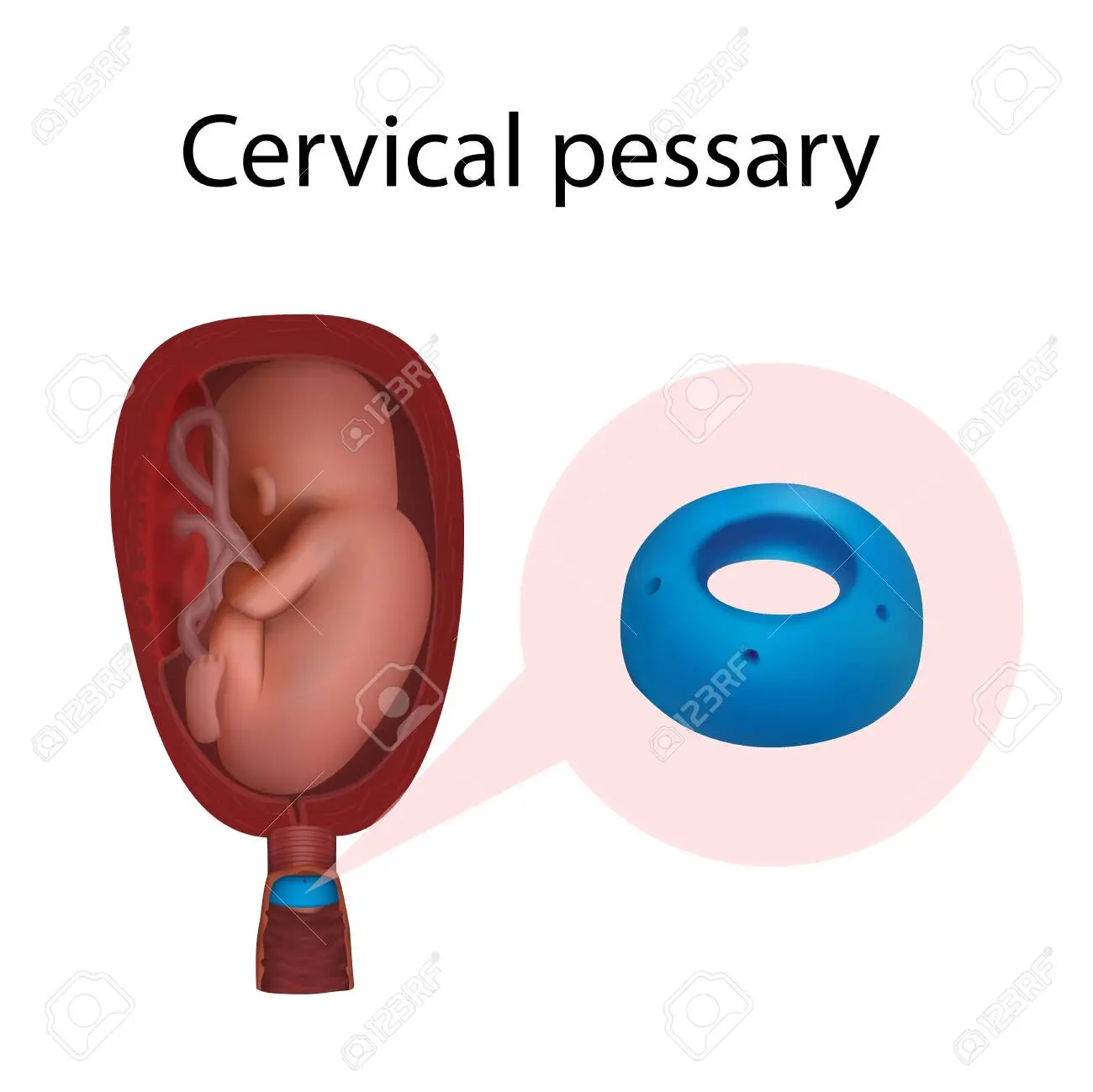 pessar schwangerschaft - Wann Pessar und Cerclage