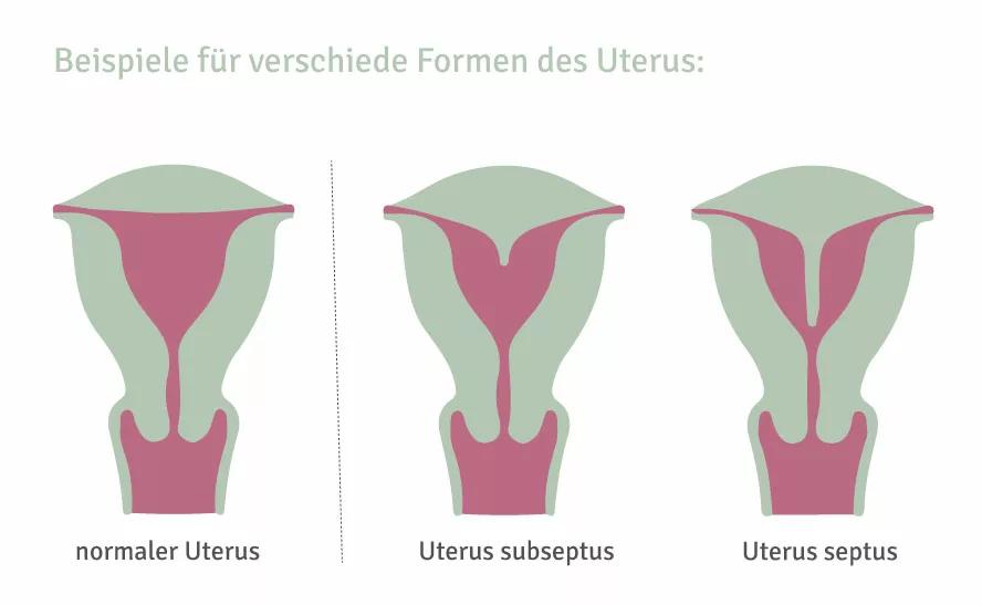 uterus subseptus schwangerschaft - Wann schwanger nach Septum Entfernung