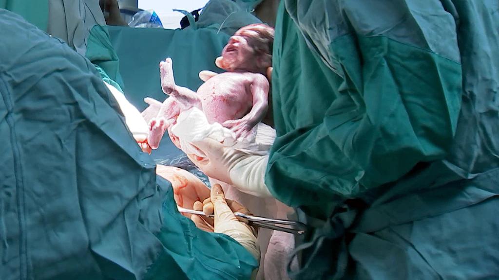 geburt zwillinge kaiserschnitt - Wann Sectio bei Zwillingen