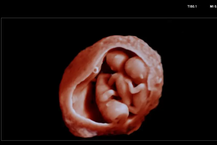 drillinge ultraschall - Wann sieht man Drillinge