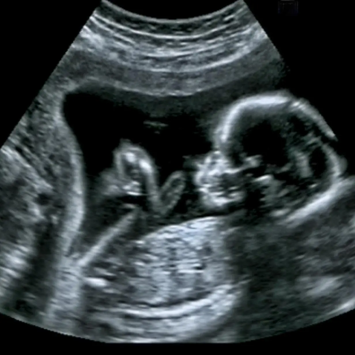 wann letzter ultraschall vor geburt - Wann sind die Ultraschall Termine