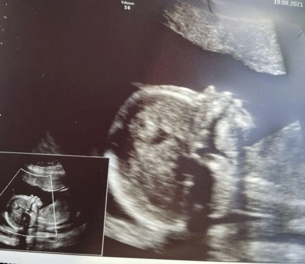 muss man bei fehlgeburt ins krankenhaus - Wann sollte man bei einer Fehlgeburt ins Krankenhaus