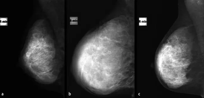 mammographie schwangerschaft - Wann sollte man keine Mammographie machen