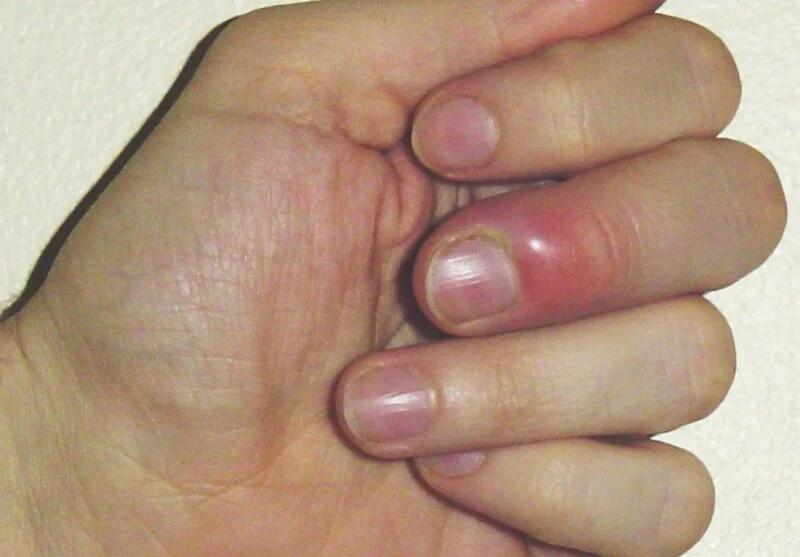 nagelbettentzündung nach geburt - Wann sollte man mit einer Nagelbettentzündung zum Arzt