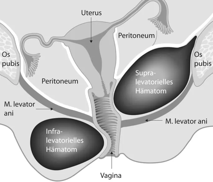Hämatom nach Geburt: Ursachen, Symptome und Behandlung - Wann verschwindet Geburtsgeschwulst hämatome nach geburt - Wann verschwindet Geburtsgeschwulst
