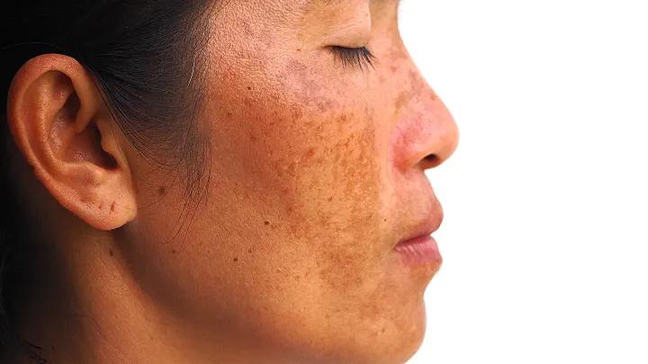 pigmentflecken nach geburt - Wann verschwindet Melasma