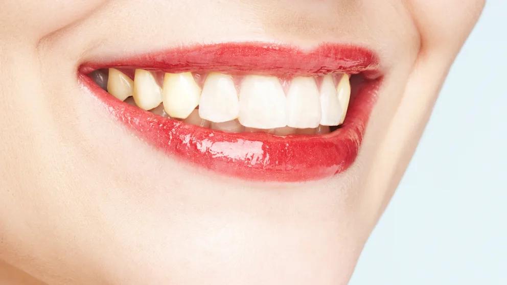 Gelbe Eckzähne: Ursachen, Vorbeugung und Behandlung - Wann werden die Zähne gelb eckzähne gelb - Wann werden die Zähne gelb