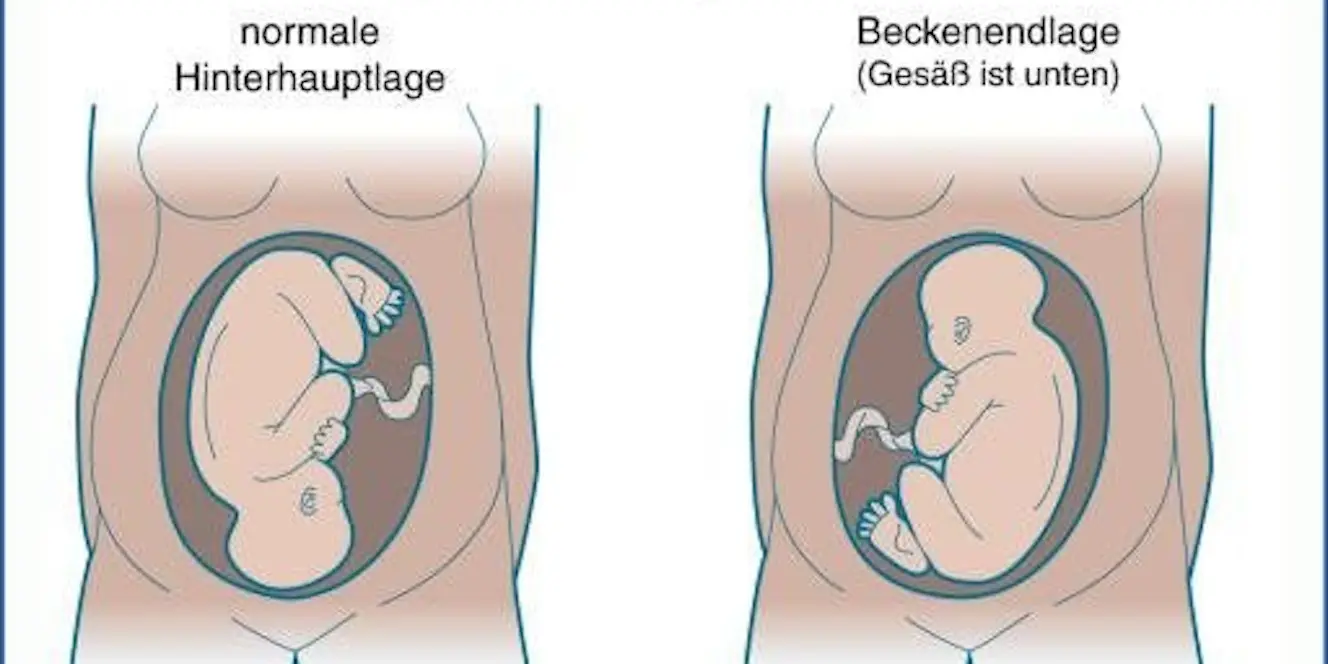 bel geburt - Wann wird ein Kaiserschnitt bei Bel gemacht