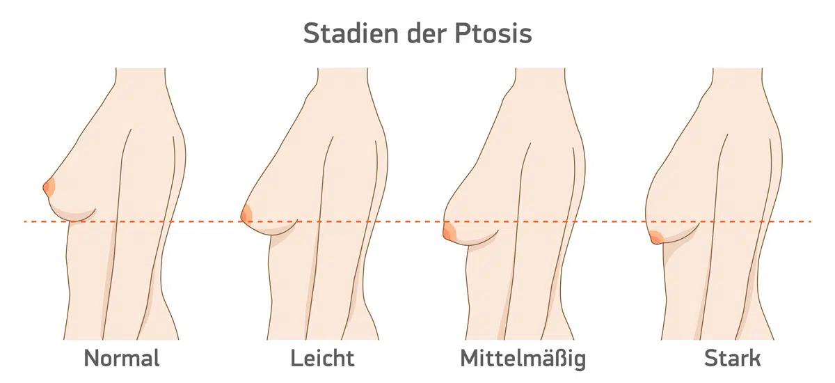 bruststraffung nach schwangerschaft krankenkasse - Wann wird eine Bruststraffung von der Krankenkasse bezahlt