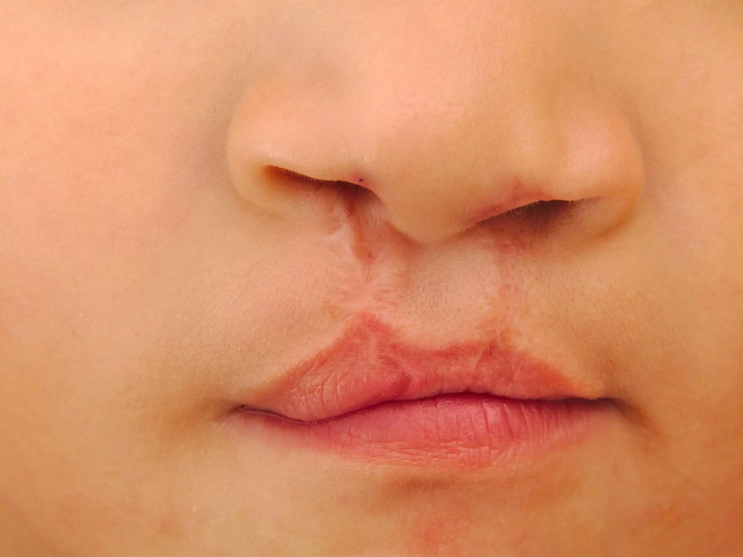 was ist eine hasenscharte - Wann wird eine Hasenscharte operiert