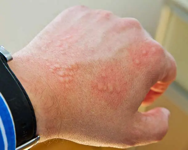 husten und ausschlag kind - Warum Ausschlag bei Erkältung