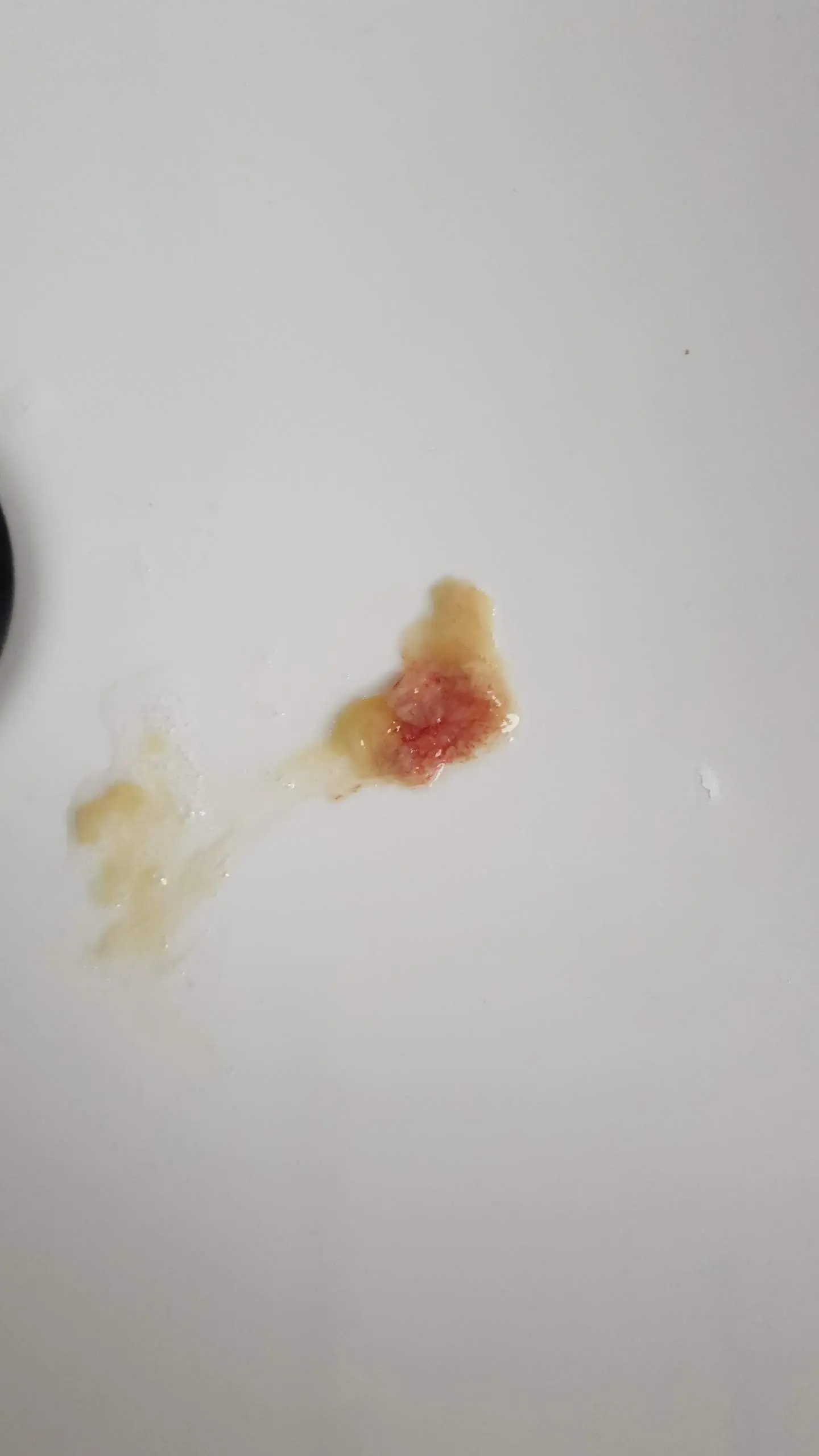 Seit 2 Wochen Blut Beim Nase Putzen Blut Im Schleim Der Nase: Ursachen, Behandlung & Vorbeugung | Hebamme FZ