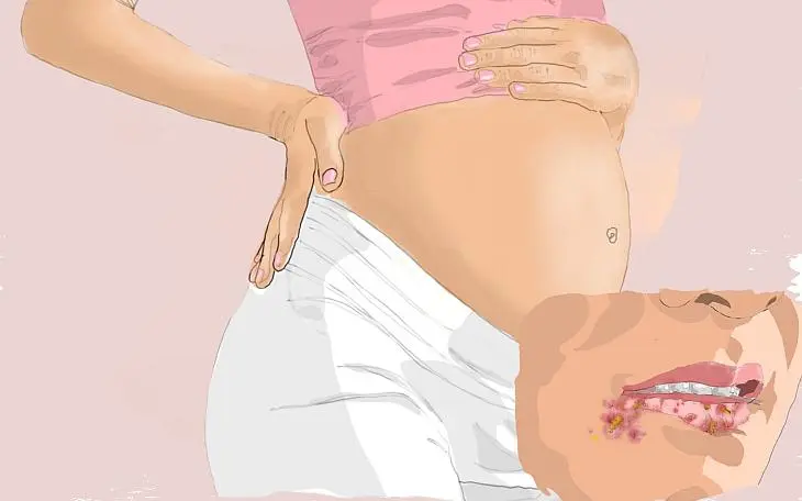 ständig herpes in der schwangerschaft - Warum bekomme ich jeden Monat Herpes