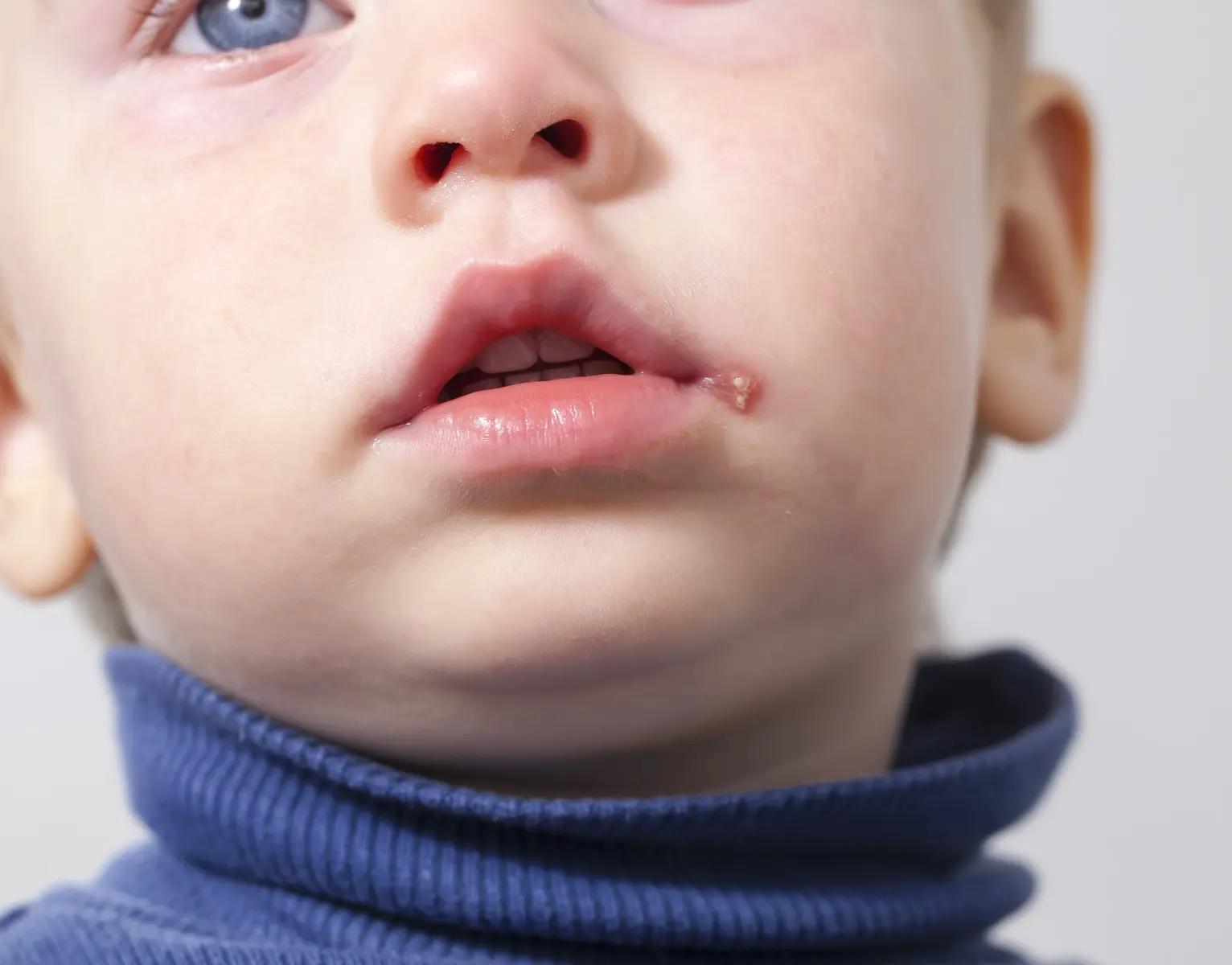 lippenherpes bei kleinkindern - Warum bekommen Kinder Lippenherpes