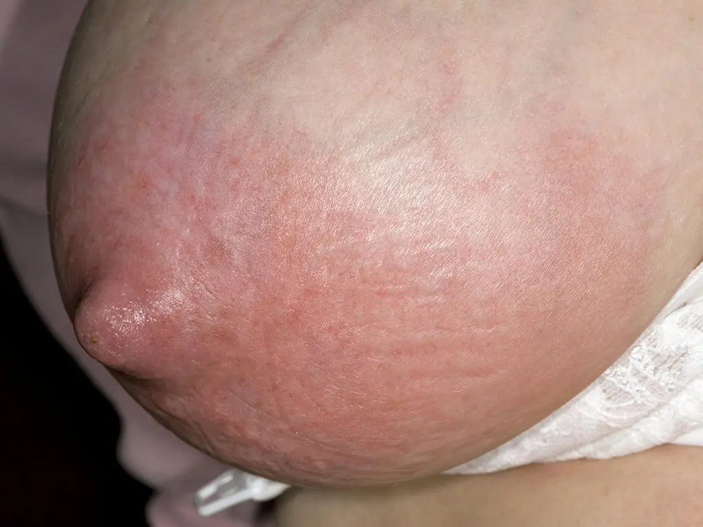 mastitis ohne schwangerschaft - Warum bekommt man Mastitis