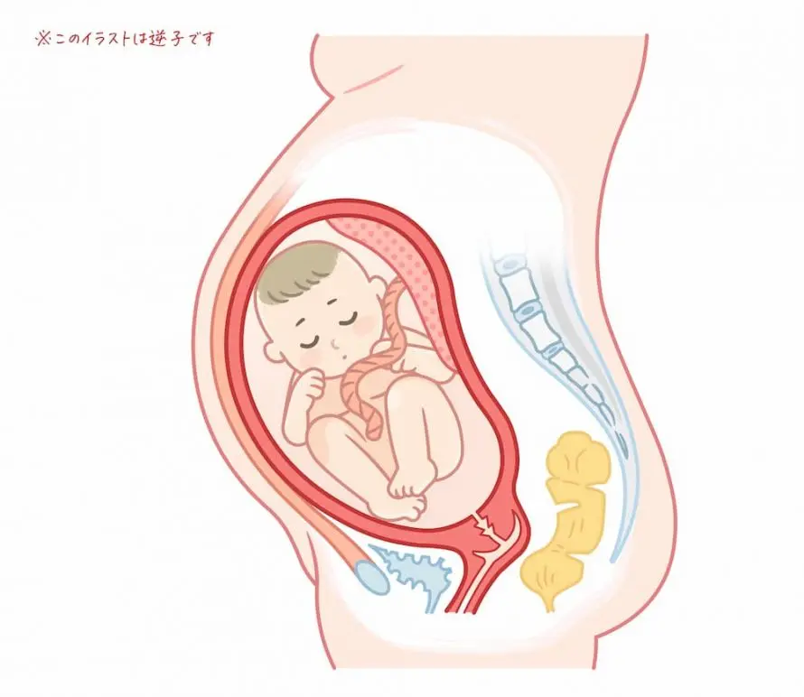 beckenendlage geburt voraussetzung - Warum bleiben Kinder in Beckenendlage