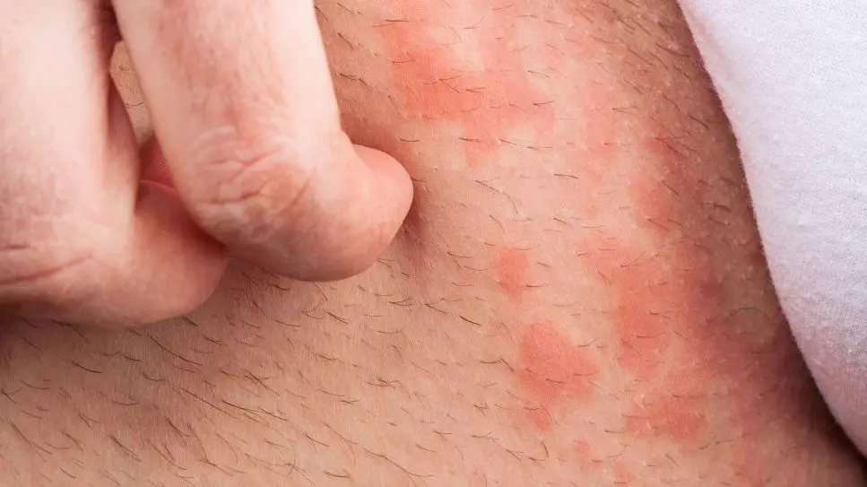 allergie durch schwangerschaft ausgelöst - Warum entstehen plötzlich Allergie