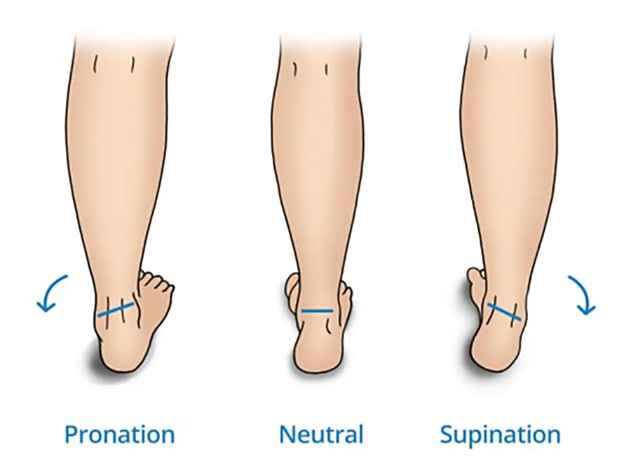 Fuß nach innen gedreht: Ursachen, Behandlung und Tipps - Warum geht mein Fuß nach innen fuß nach innen gedreht - Warum geht mein Fuß nach innen