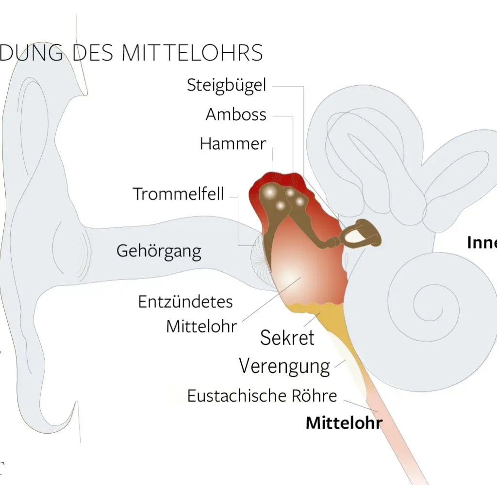 verschleppte mittelohrentzündung erwachsene - Warum geht meine Mittelohrentzündung nicht weg