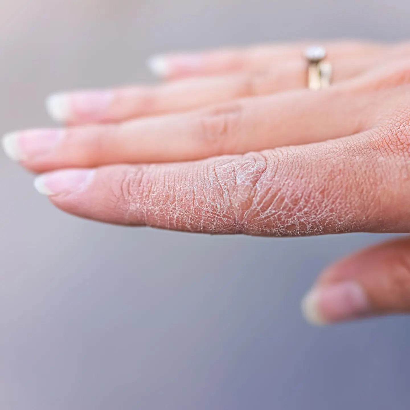 trockene hände nach geburt - Warum habe ich extrem trockene Hände