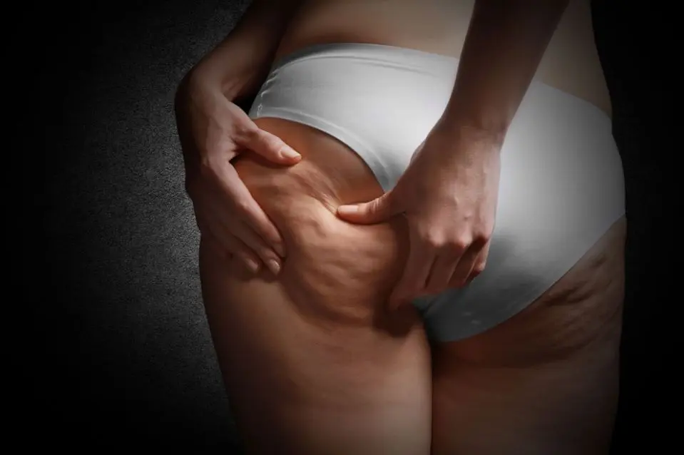 cellulite schwangerschaft - Warum habe ich plötzlich so viel Cellulite