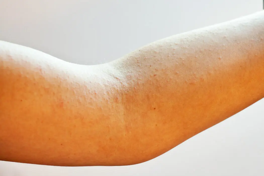 rote flecken nach geburt mutter - Warum habe ich rote Flecken