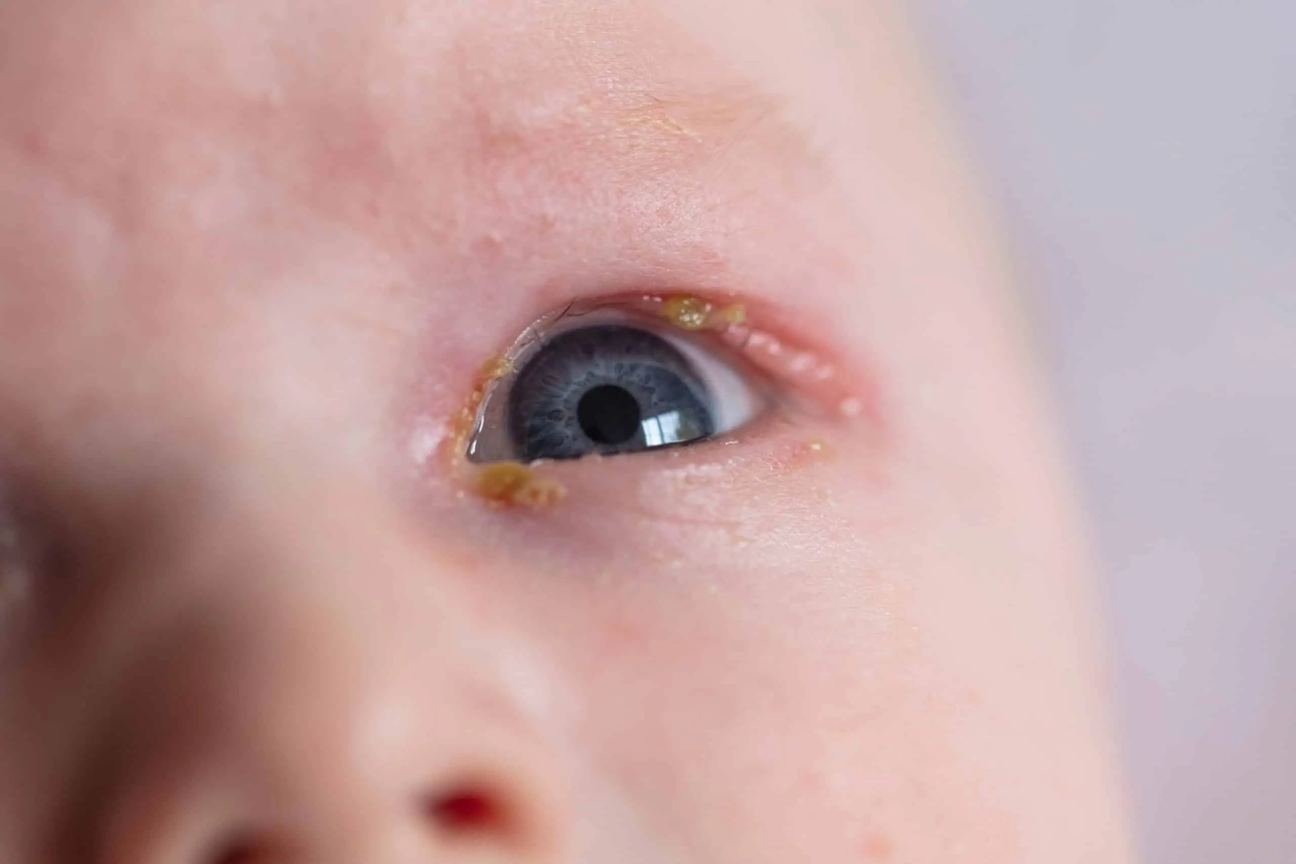 baby auge tränt und gelber schleim - Warum hat mein Baby Schleim im Auge