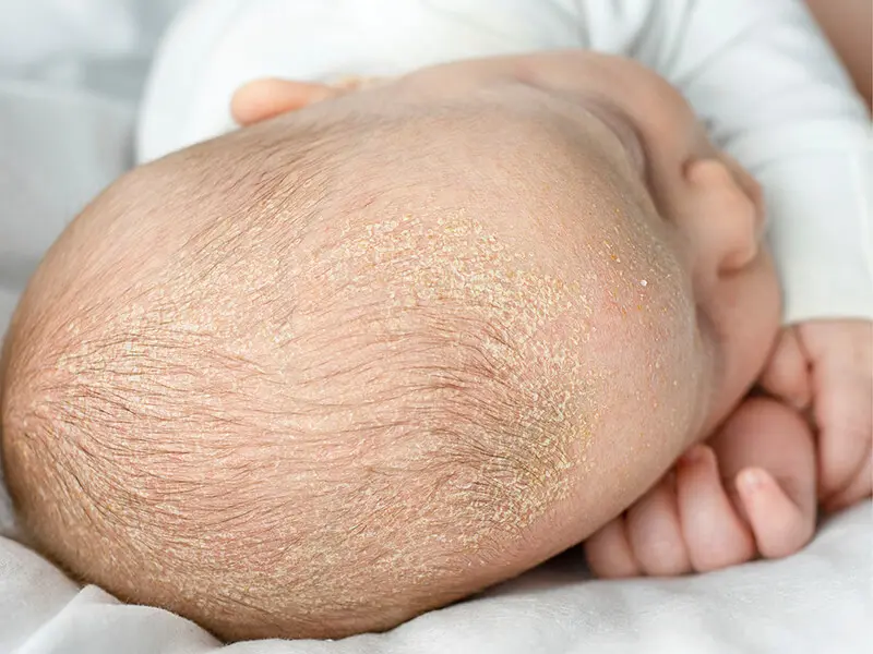 baby schuppen kopf - Warum hat mein Kind so viele Schuppen